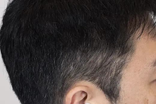 42세 모발이식 100모 10개월 컷 2 사진