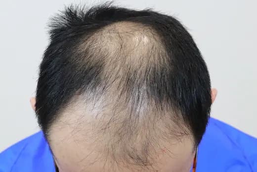 46세 모발이식 4000모 탈모치료 10회 12개월 컷 1 사진