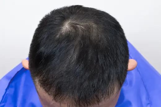 46세 모발이식 4000모 탈모치료 10회 12개월 컷 2 사진