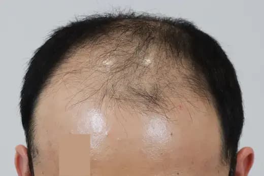 46세 모발이식 4000모 탈모치료 10회 12개월 컷 1 사진