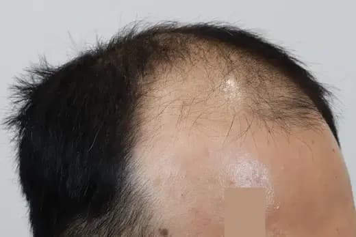 46세 모발이식 4000모 탈모치료 10회 12개월 컷 1 사진