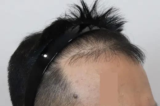 46세 모발이식 4000모 탈모치료 10회 12개월 컷 2 사진