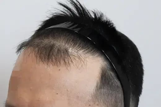 46세 모발이식 4000모 탈모치료 10회 12개월 컷 2 사진
