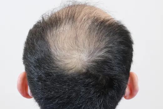 46세 모발이식 4000모 탈모치료 10회 12개월 컷 1 사진