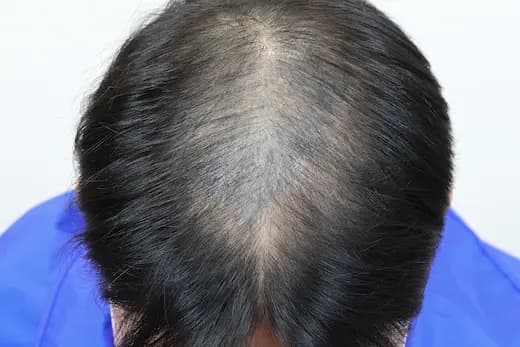 26세 탈모치료 30회 12개월 컷 1 사진