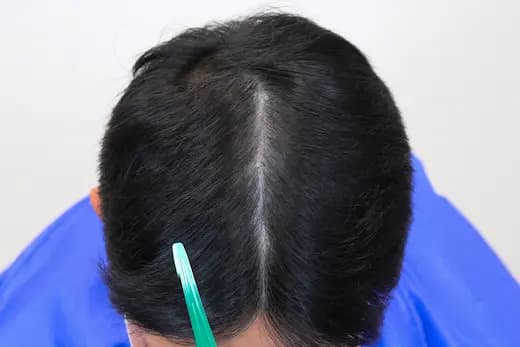 26세 탈모치료 30회 12개월 컷 2 사진