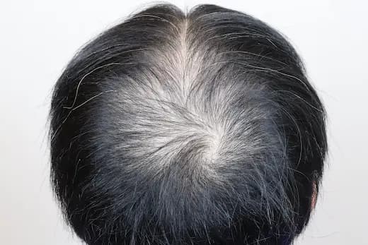 36세 탈모치료 17회 5개월 컷 1 사진