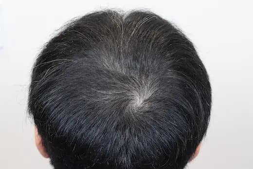 36세 탈모치료 17회 5개월 컷 2 사진