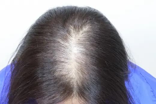 46세 모발이식 4000모 탈모치료 20회 두피문신 6회 12개월 컷 1 사진