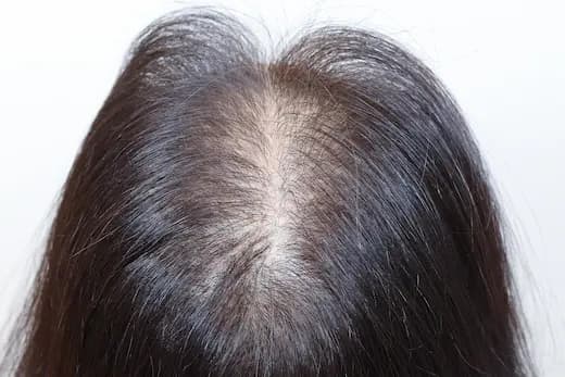 46세 모발이식 4000모 탈모치료 20회 두피문신 6회 12개월 컷 1 사진