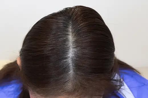 60세 탈모치료 20회 7개월 컷 2 사진