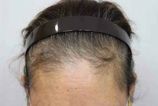 60세 탈모치료 20회 7개월 컷 1 사진