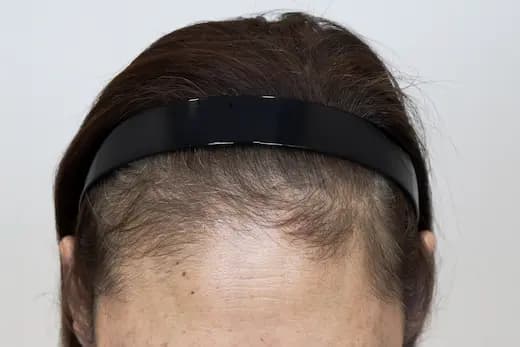 60세 탈모치료 20회 7개월 컷 2 사진