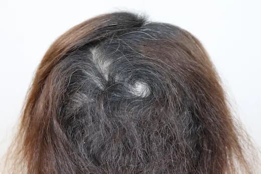 60세 탈모치료 20회 7개월 컷 1 사진