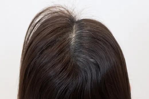 60세 탈모치료 20회 7개월 컷 2 사진