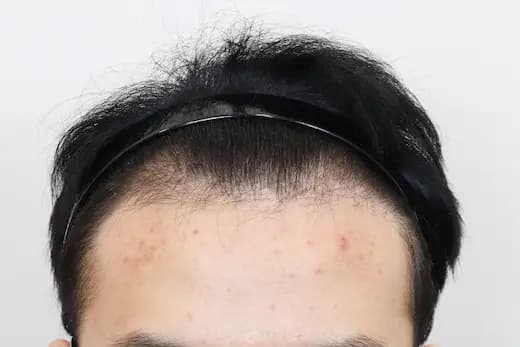 19세 모발이식 3500모 9개월 컷 1 사진