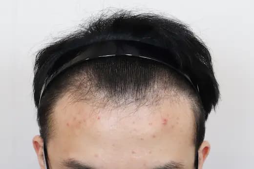 19세 모발이식 3500모 9개월 컷 1 사진