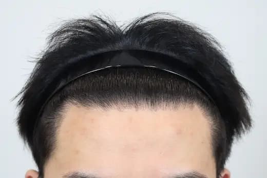 19세 모발이식 3500모 9개월 컷 2 사진