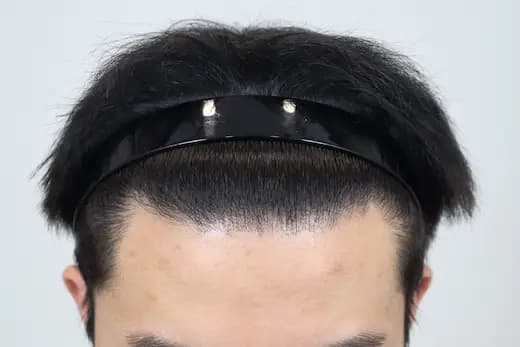 19세 모발이식 3500모 9개월 컷 2 사진