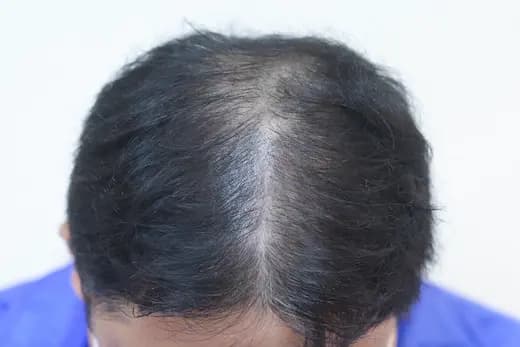 38세 탈모치료 20회 5개월 전 사진