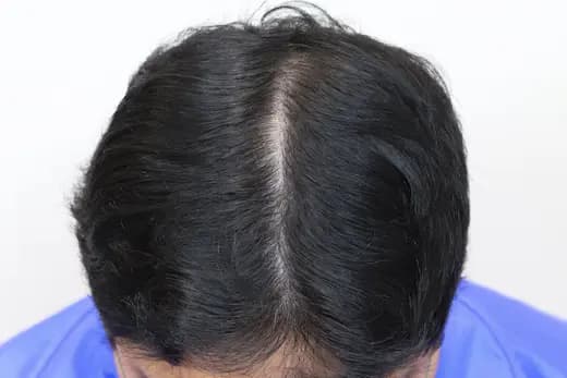 38세 탈모치료 20회 5개월 후 사진