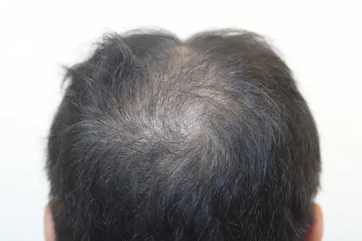 38세 탈모치료 20회 5개월 컷 1 사진