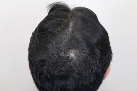 38세 탈모치료 20회 5개월 컷 2 사진