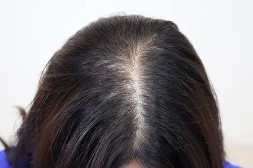 31세 두피문신 8회 5개월 컷 1 사진