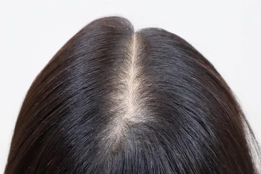 31세 두피문신 8회 5개월 컷 1 사진