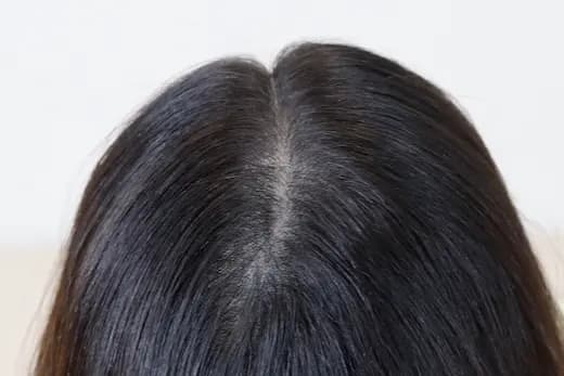 31세 두피문신 8회 5개월 컷 2 사진