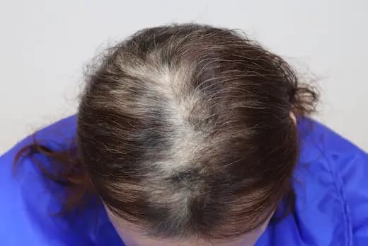 51세 탈모치료 10회 4개월 컷 1 사진