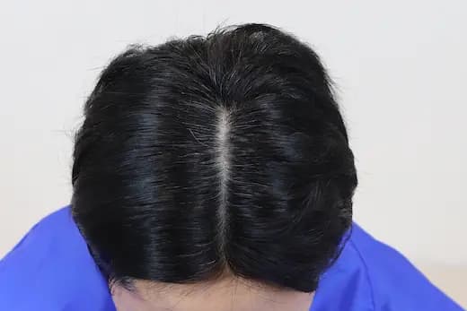 51세 탈모치료 10회 4개월 컷 2 사진