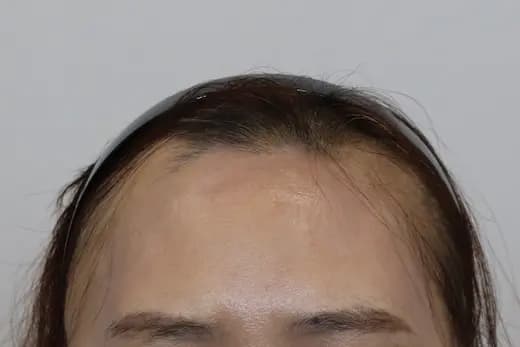 51세 탈모치료 10회 4개월 컷 1 사진