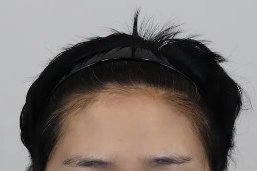 51세 탈모치료 10회 4개월 컷 2 사진