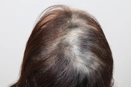 51세 탈모치료 10회 4개월 컷 1 사진