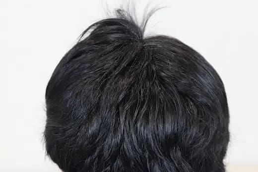 51세 탈모치료 10회 4개월 컷 2 사진