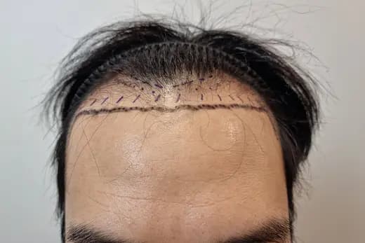 34세 모발이식 3000모 9개월 컷 1 사진