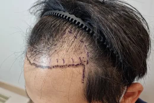 34세 모발이식 3000모 9개월 컷 1 사진
