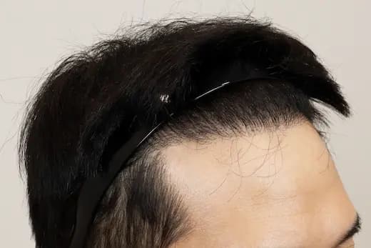 34세 모발이식 3000모 9개월 컷 2 사진