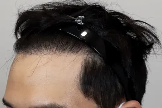 34세 모발이식 3000모 9개월 컷 2 사진