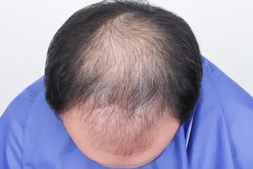 22세 모발이식 4000모 탈모치료 10회 12개월 컷 1 사진