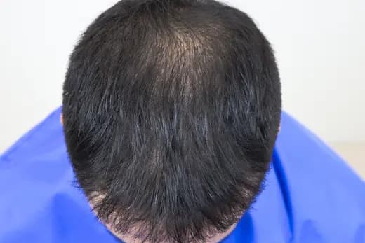 22세 모발이식 4000모 탈모치료 10회 12개월 컷 2 사진