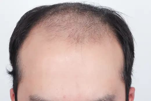 22세 모발이식 4000모 탈모치료 10회 12개월 컷 1 사진