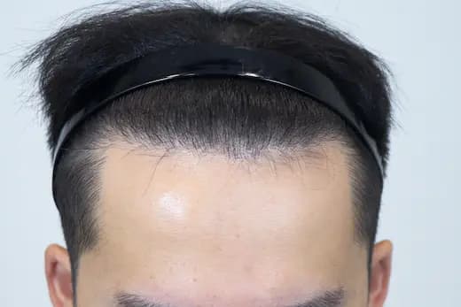 22세 모발이식 4000모 탈모치료 10회 12개월 컷 2 사진