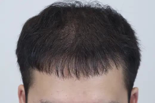 22세 모발이식 4000모 탈모치료 10회 12개월 컷 2 사진