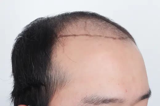 22세 모발이식 4000모 탈모치료 10회 12개월 컷 1 사진