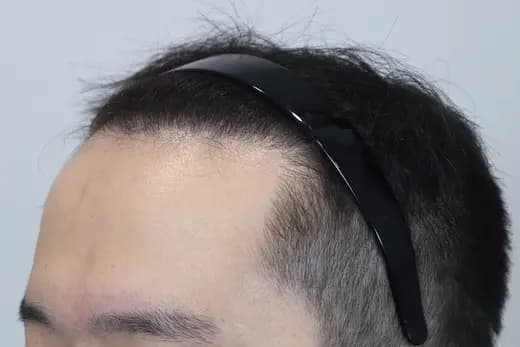 22세 모발이식 4000모 탈모치료 10회 12개월 컷 2 사진