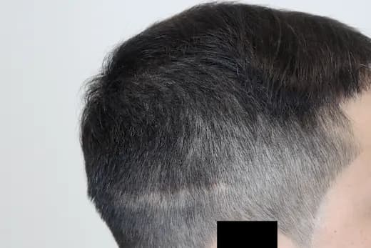 22세 두피문신 3회 1개월 컷 1 사진