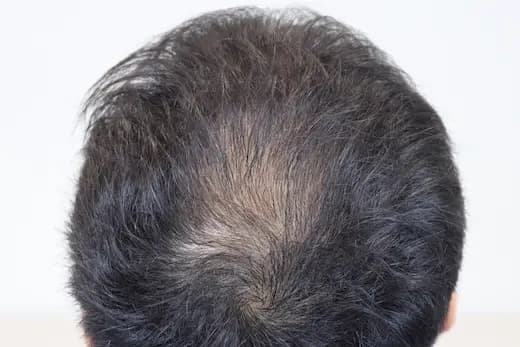 22세 두피문신 3회 1개월 컷 1 사진