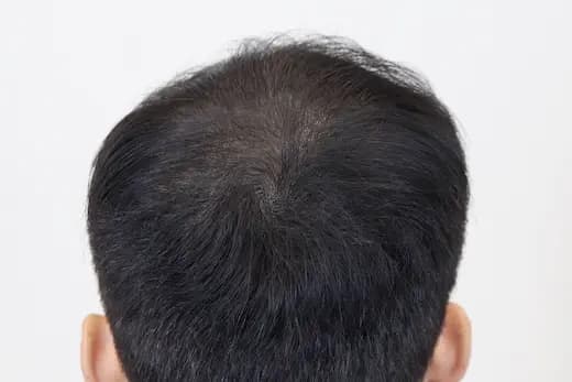 22세 두피문신 3회 1개월 컷 2 사진